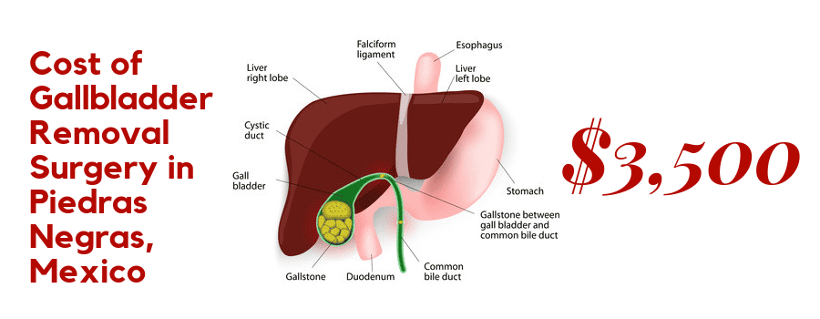 Cost of Gallbladder Removal Surgery in Piedras Negras, Mexico